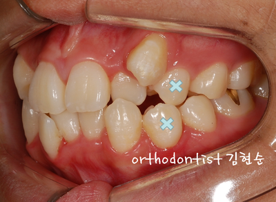 강남 덧니 관련 이미지 13