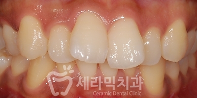돌출입치아교정 전후사진(발치교정, 토끼이빨 인상변화) 관련 이미지 3