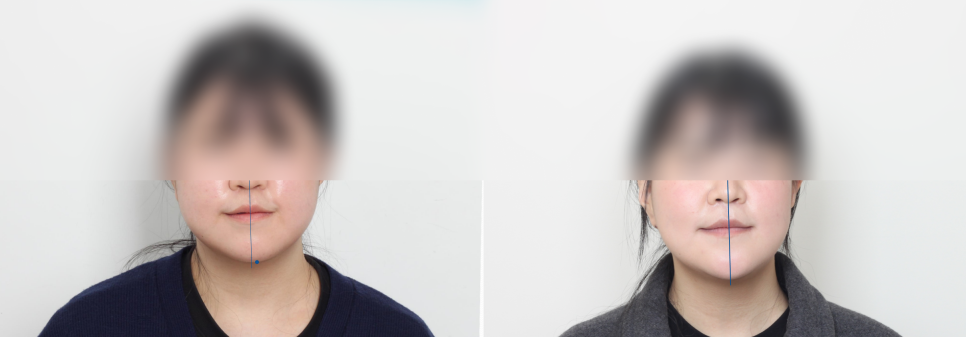 학동역 교정치과, 개방교합과 비대칭을 수술없이 교정한 경우 관련 이미지 13