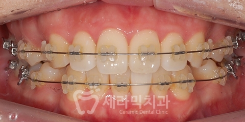 20대 돌출입교정, 무턱교정, 치아교정전후 세련된 얼굴 라인을 되찾다! 관련 이미지 1