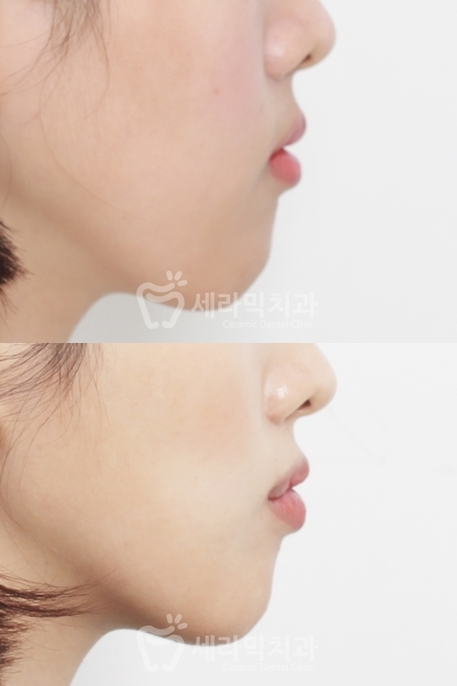 Open Bite Dental Clinic Orthodontic Before and After: Did a Long-Looking Jaw Become Shorter? image 12