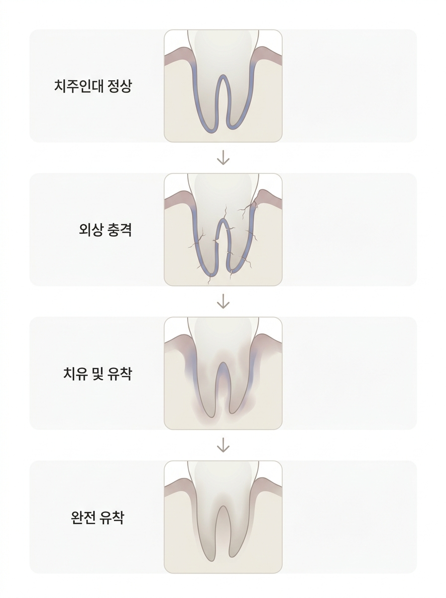 치아 유착(ankylosis)이란? 아이 유치가 안 빠지고 낮게 보일 때 확인할 점 관련 이미지 5