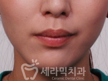 덧니와 돌출입을 한번에! 치아교정 전후사진 관련 이미지 3
