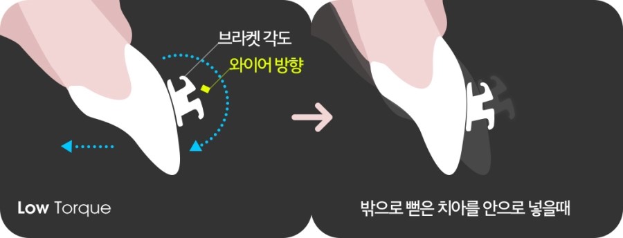 치아각도 교정과정 관련 이미지 6