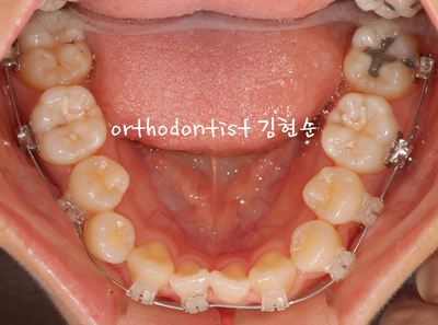 개방 교합 관련 이미지 18