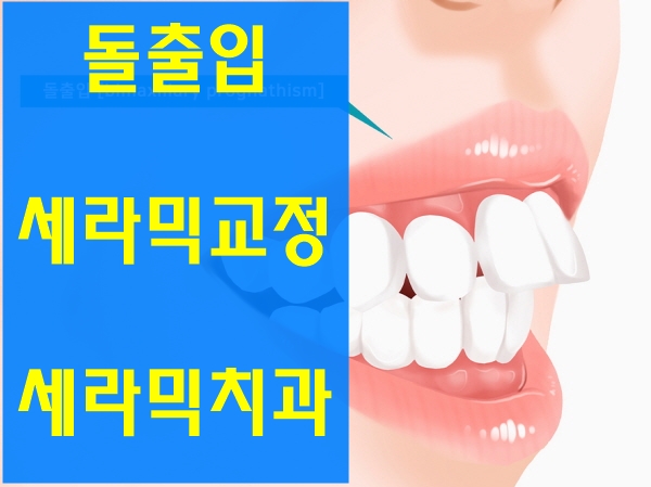 학동역 치아교정, 돌출입 세라믹교정 관련 이미지 1