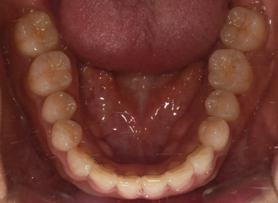 과개교합 교정: 비수술로 치료한 토끼 이빨 이야기 관련 이미지 12