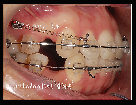 강남교정치과 관련 이미지 25