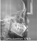 강남 돌출입 교정 관련 이미지 21