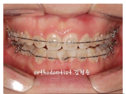 강남 과개 교합 관련 이미지 7