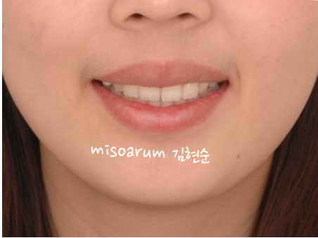 강남 돌출입 교정 관련 이미지 35