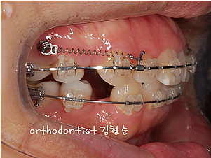 강남 돌출입 교정 관련 이미지 30