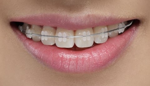 세라믹교정 세라믹치과 관련 이미지 1