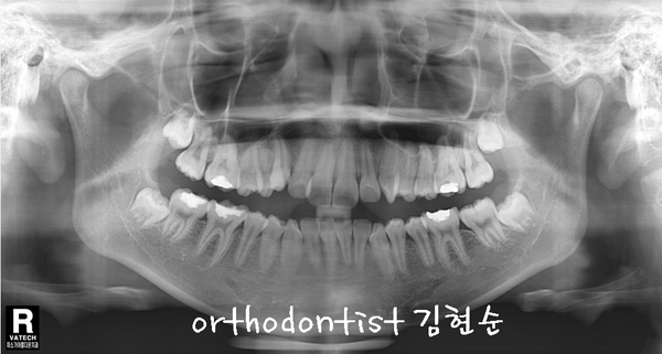 강남 돌출 (토끼 치아) 관련 이미지 12