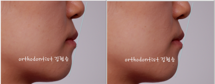 강남 덧니 관련 이미지 8