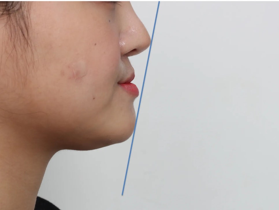 언주역 치과, 주걱턱 + 과개교합을 비수술로 치료한 사례 관련 이미지 4