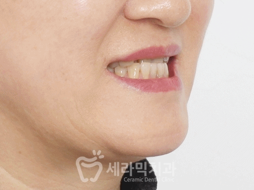 40대에 이어 50대 치아교정 전후사례 증가 추세 관련 이미지 18