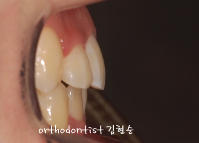 반대교합 관련 이미지 19