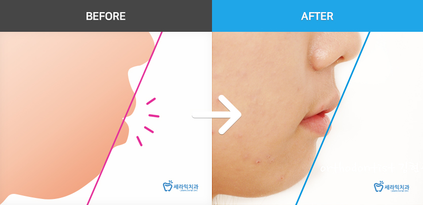 학동역치과 미국3M교정 추천 ~~ 관련 이미지 15