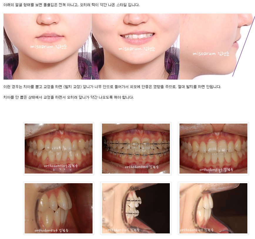 치아의 배열을 개선, 발치하지 않고 교정하기 관련 이미지 5