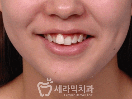 돌출입과 치열불규칙 치아교정 전후 : 자신감 넘치는 미소! 관련 이미지 2