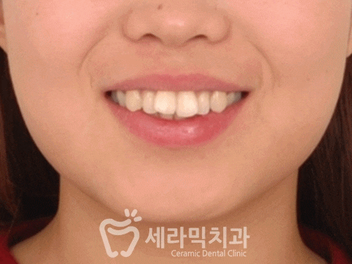 압구정교정치과 세라믹치과 토끼이빨 치아교정전후 관련 이미지 1
