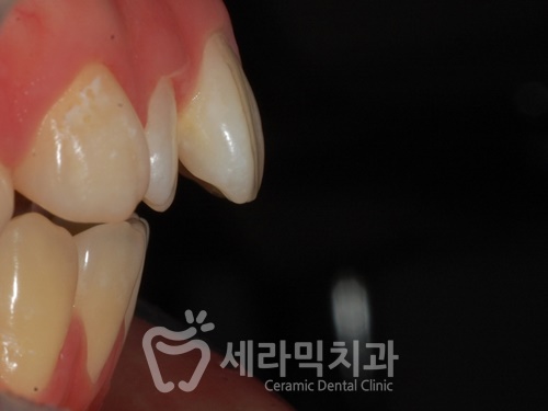 앞니 돌출, 개방교합으로 치아교정을 시작했는데, 작았던 아래턱이 커졌어요! 관련 이미지 3