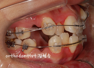 강남 덧니 관련 이미지 17