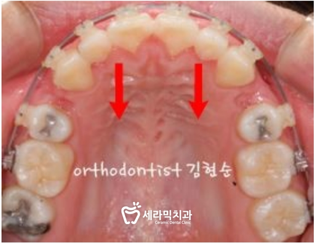 돌출 교정 월15만원 관련 이미지 7
