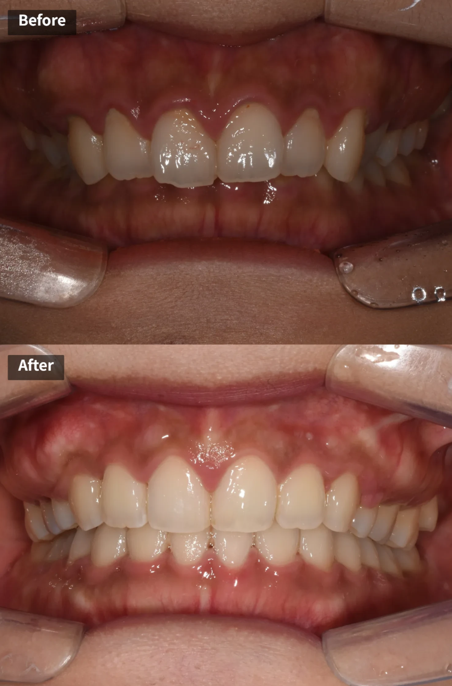 과개교합 교정: 비수술로 치료한 토끼 이빨 이야기 관련 이미지 1