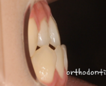 주걱턱수술 안하고 양악수술 안하고 관련 이미지 1