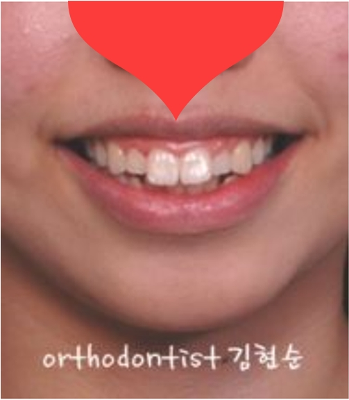 돌출 교정 월15만원 관련 이미지 6