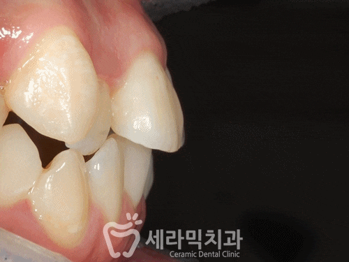돌출입과 치아배열 치아교정전후 관련 이미지 2