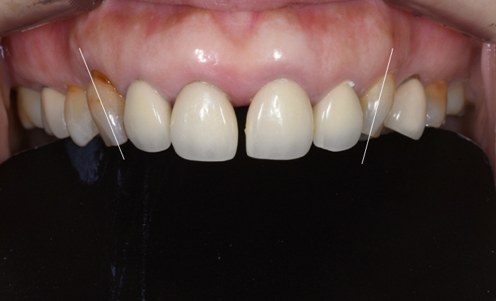 일본에서 거절당했던 앞니 심미보철 크라운 관련 이미지 5