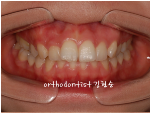 강남 돌출입 교정 관련 이미지 12