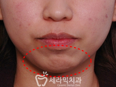 돌출입 잇몸노출 치아교정 전후 인상변화 사례 관련 이미지 3