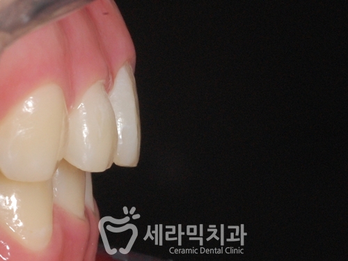 돌출입교정, 심미성과 치아 건강을 동시에 해결! 관련 이미지 27