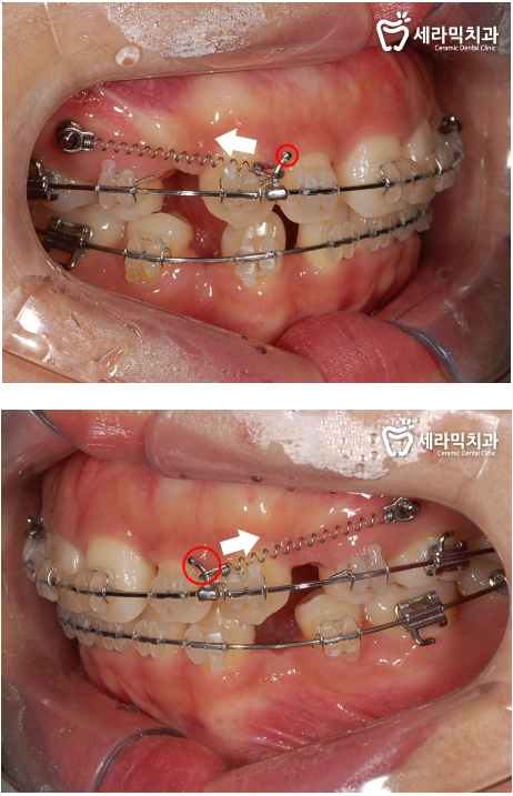 돌출 교정 월15만원 관련 이미지 4