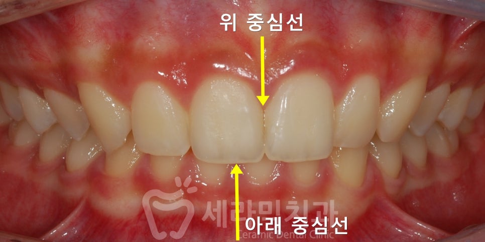 과개교합, 딥바이트 비발치 치아교정전후 관련 이미지 4