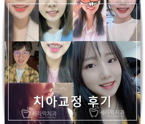 A Case of Overretained Teeth and Deep Bite Orthodontics That Helped the Patient Smile Confidently Before and After image 14