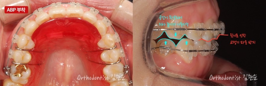 과개교합 무턱 개선 관련 이미지 7