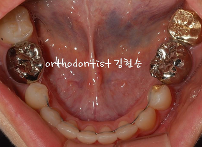 강남 돌출입 교정 관련 이미지 20