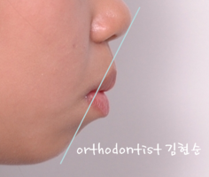 미니스크류를 이용한 발치 돌출입 교정, 무턱 개선 관련 이미지 1