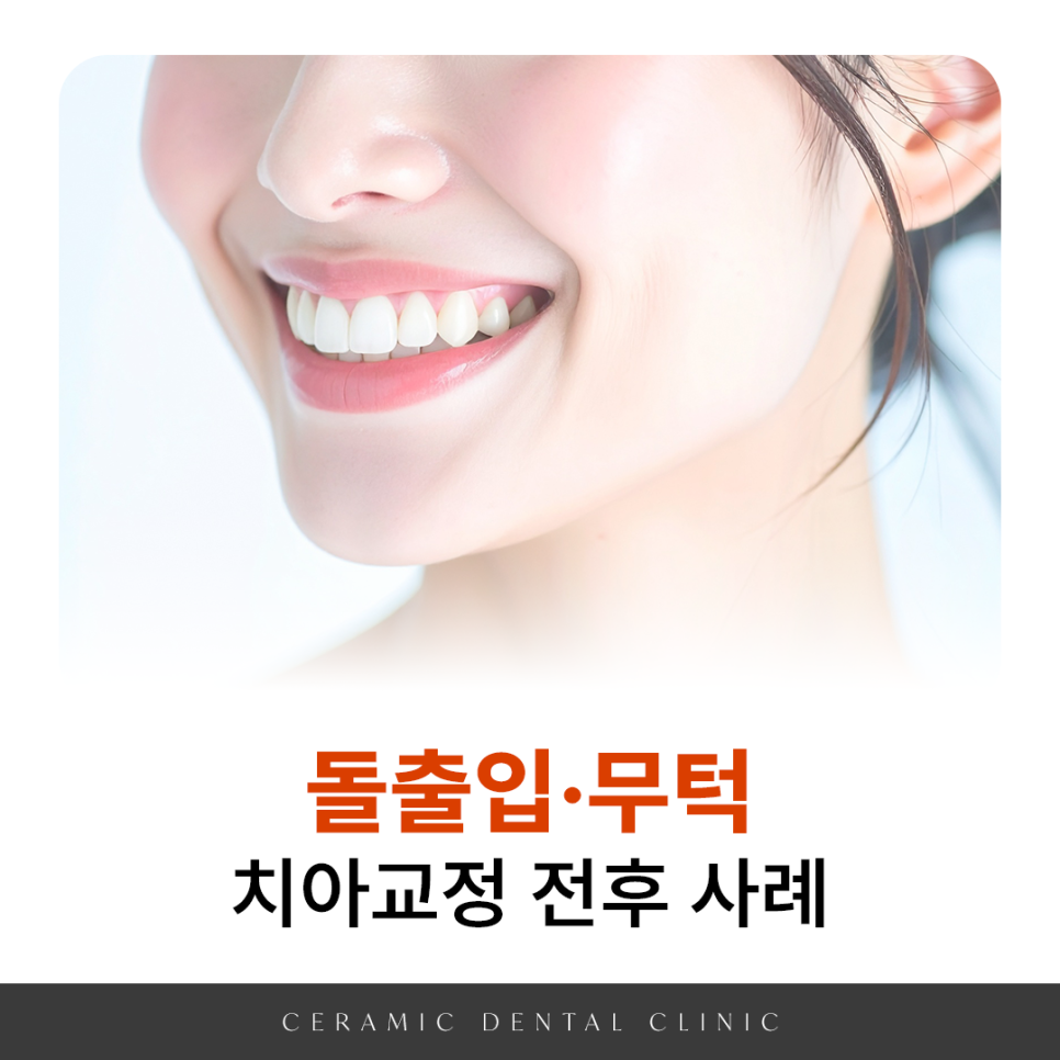 20대 돌출입교정, 무턱교정, 치아교정전후 세련된 얼굴 라인을 되찾다! 관련 이미지 3