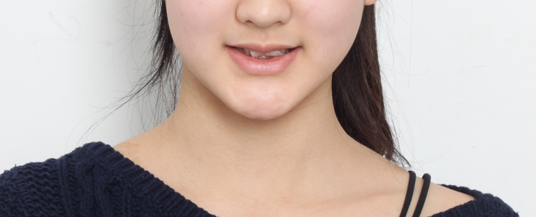 왜소치, 결손치가 동시에 있었던 환자의 앞니 심미보철 관련 이미지 2