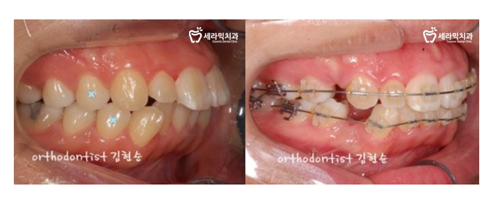 돌출입 교정으로 외모변화를 확인 관련 이미지 8