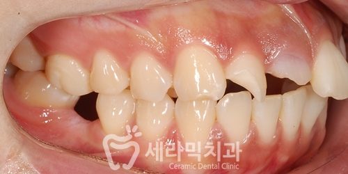 깨진 후에 후회하는 돌출입, 치아교정으로 건강하고 가지런한 치아만들기 관련 이미지 3