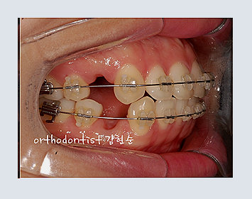 강남교정치과 관련 이미지 20