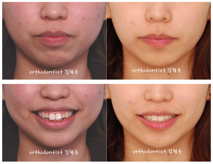 미니스크류, 돌출입 발치 교정 잇몸노출 개선 관련 이미지 11