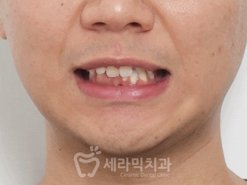 A Case of Overretained Teeth and Deep Bite Orthodontics That Helped the Patient Smile Confidently Before and After image 12
